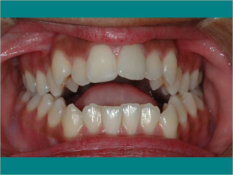 bite open treatment orthodontic therapy example speech role openbite