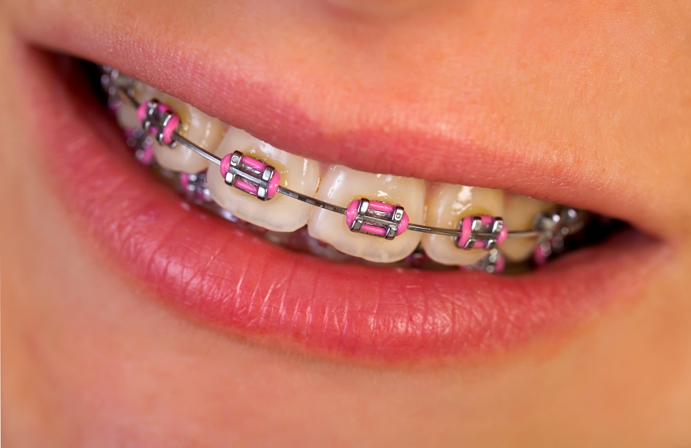 How Braces Work to Straighten Your Teeth - Pacific West Dental