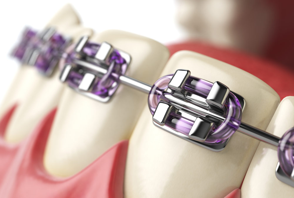 Does your health care plan cover orthodontics?