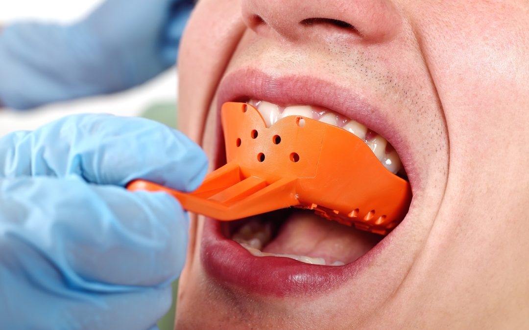 Dental Impressions Pacific West Dental Blog