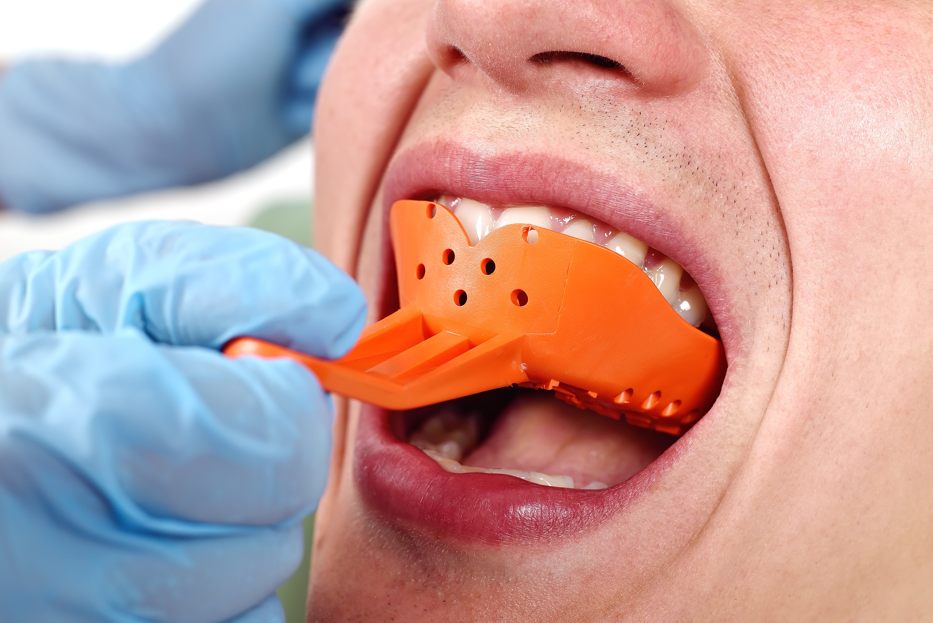 dental impressions dentures teeth impression taking types dentist immediate process pacific west