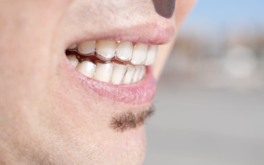 Common Causes of Poor Teeth Alignment