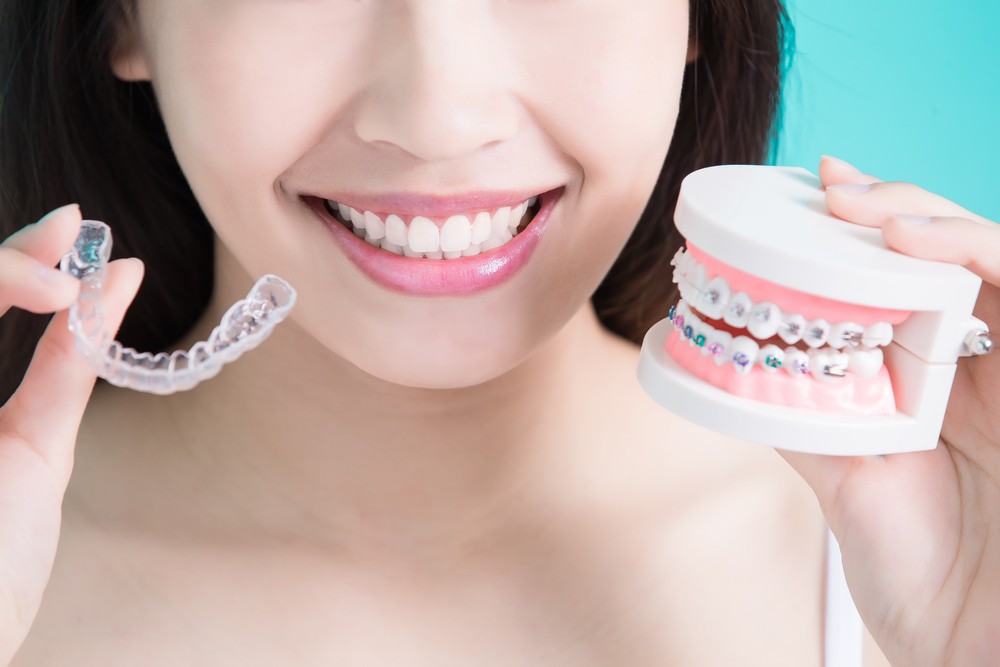 Clear Braces or Metal Braces – How to Choose?