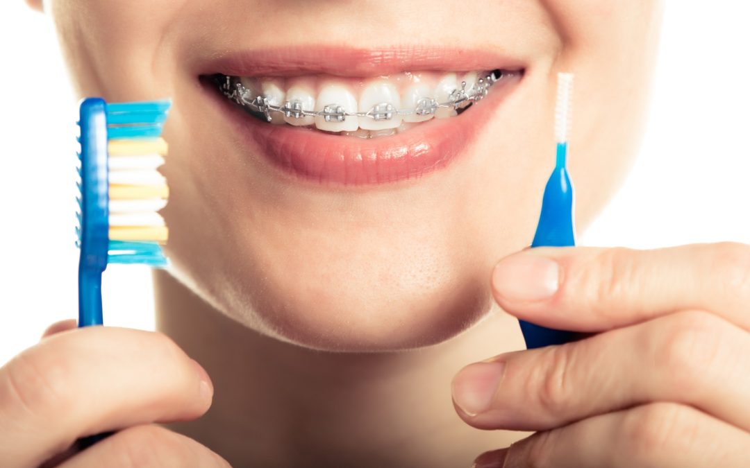 Tips to Keep Your Braces Clean