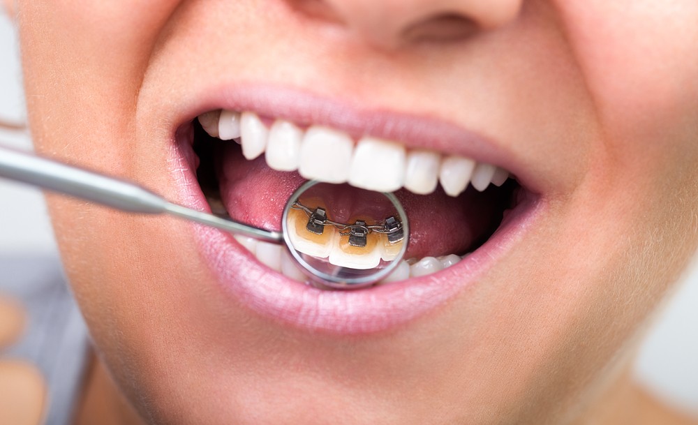 Advantages of Lingual Braces