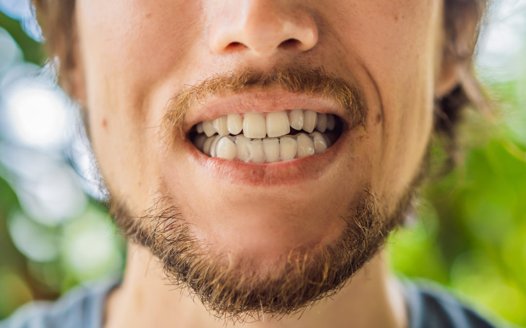 Four Signs You Might Have a Bite Issue