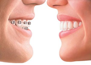 two mouths with invisalign and metal braces smiling