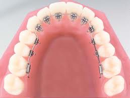 lingual braces