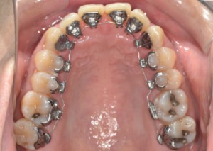 2003Upper Occlusal-Progress 1