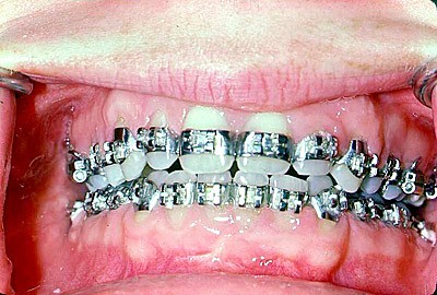 braces banded all teeth6/29/00 Hand Out photo FEATURES