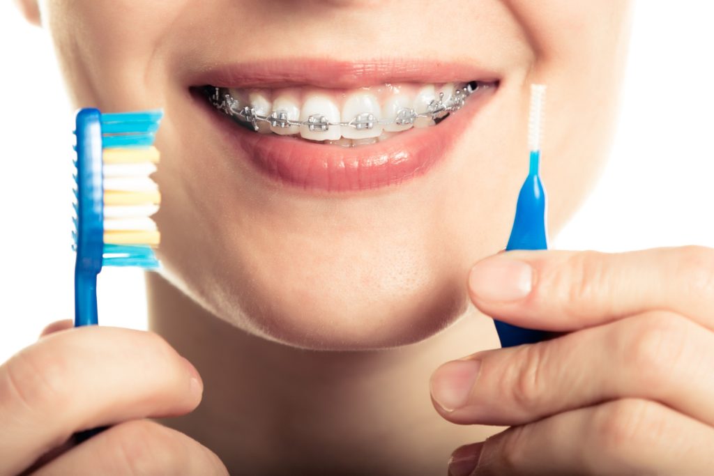 Types of Braces  Braces in Vancouver & Lower Mainland BC