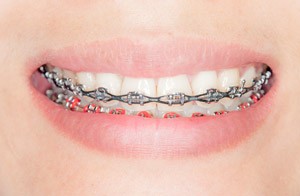 braces chain