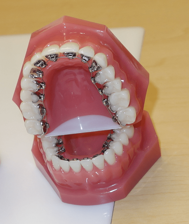 What Are Lingual Braces?  PacificWest Orthodontists Vancouver