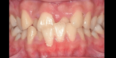 Crowded teeths patient