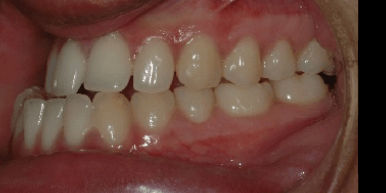 Underbite Issue