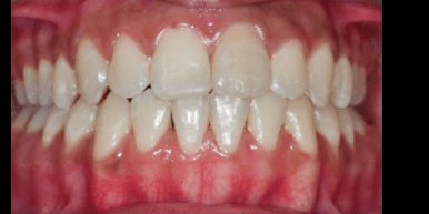 Invisalign clear braces, fast arrangement, easy to remove, no need to pay a  lot