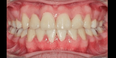 crowded teeth