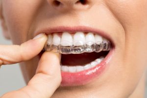 Invisalign-invisible-teeth at Pacific West Dental