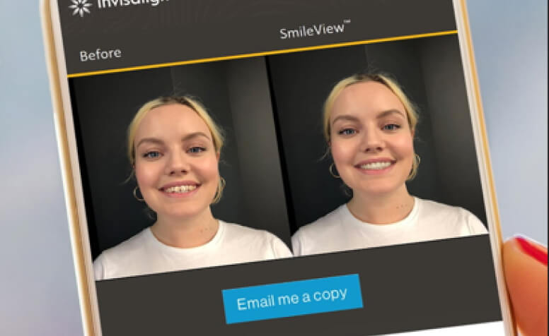 Smile View - Before & After of Woman