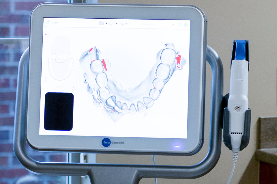 itero-scanner at Pacific West Dental