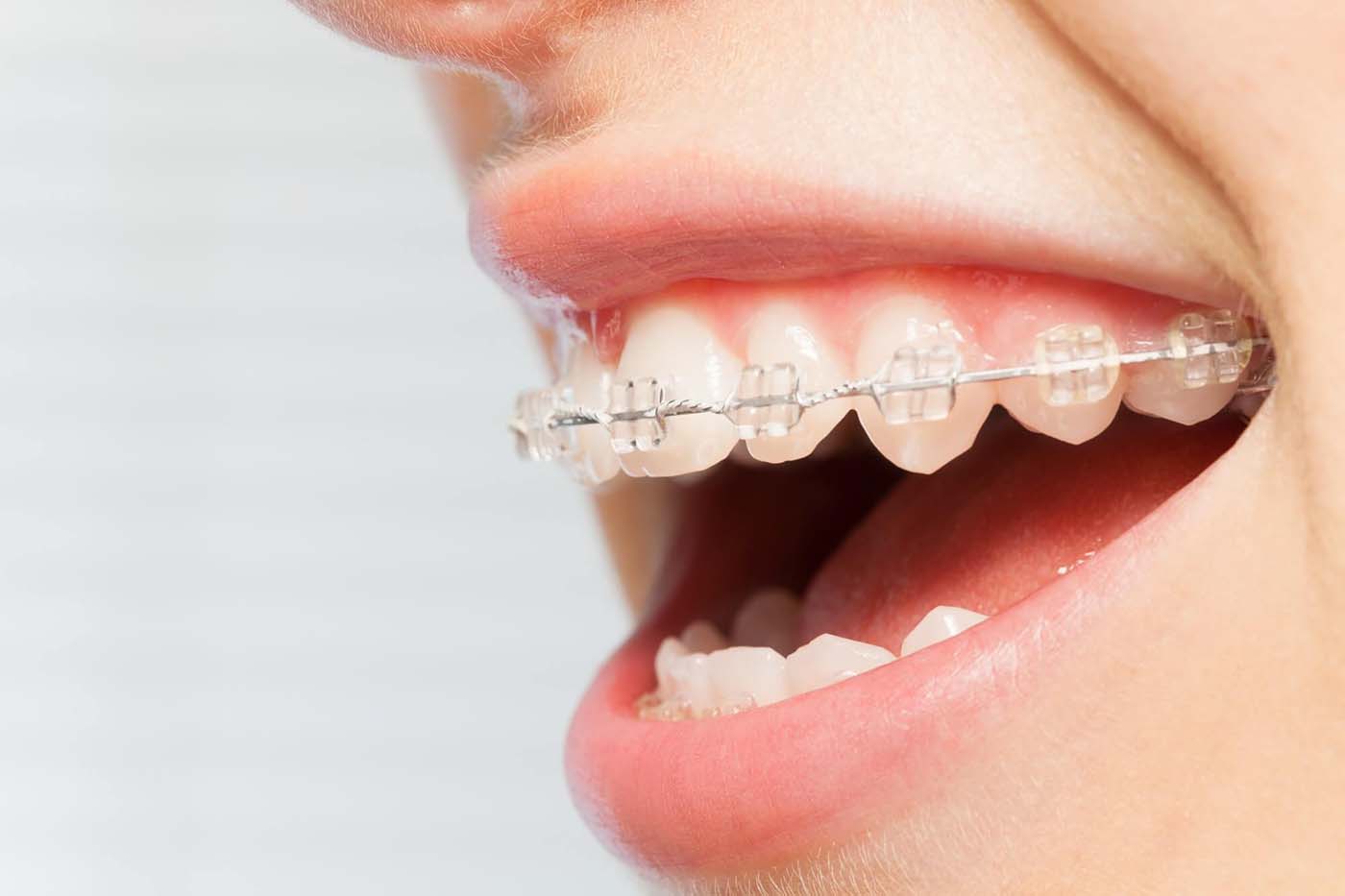 The Different Types of Braces - Westermeier Martin Dental Care