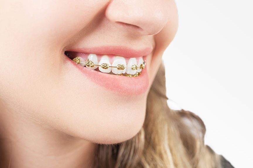 Gold Braces