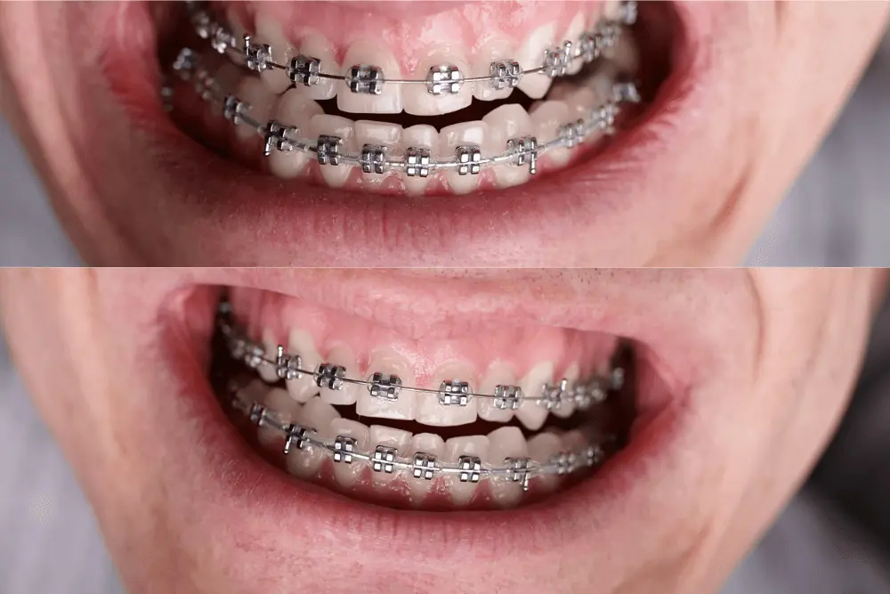 Damon Braces