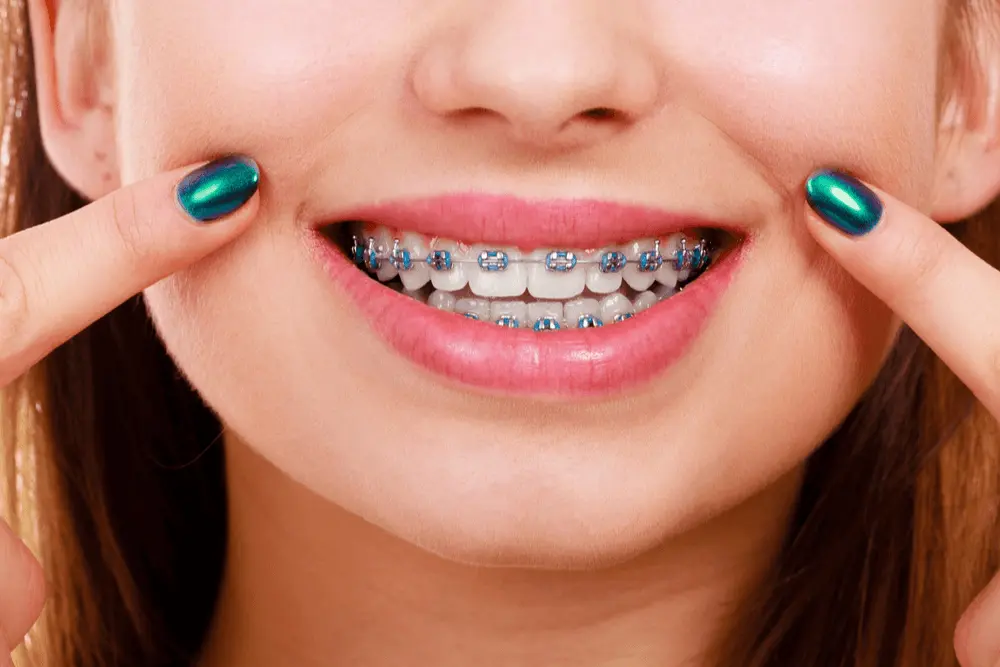 Smile in Metal Braces