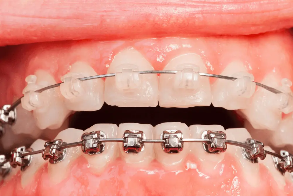 Traditional Metal Braces